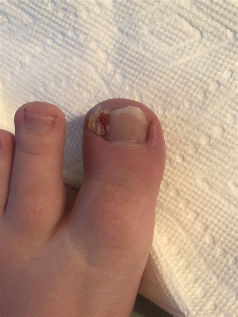 reddit ingrown toenail